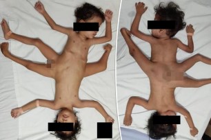 Scientists are flabbergasted over ultra-rare conjoined "spider" twins in Indonesia who are connected at the pelvis in such a way that they possess three legs, four arms and one penis.